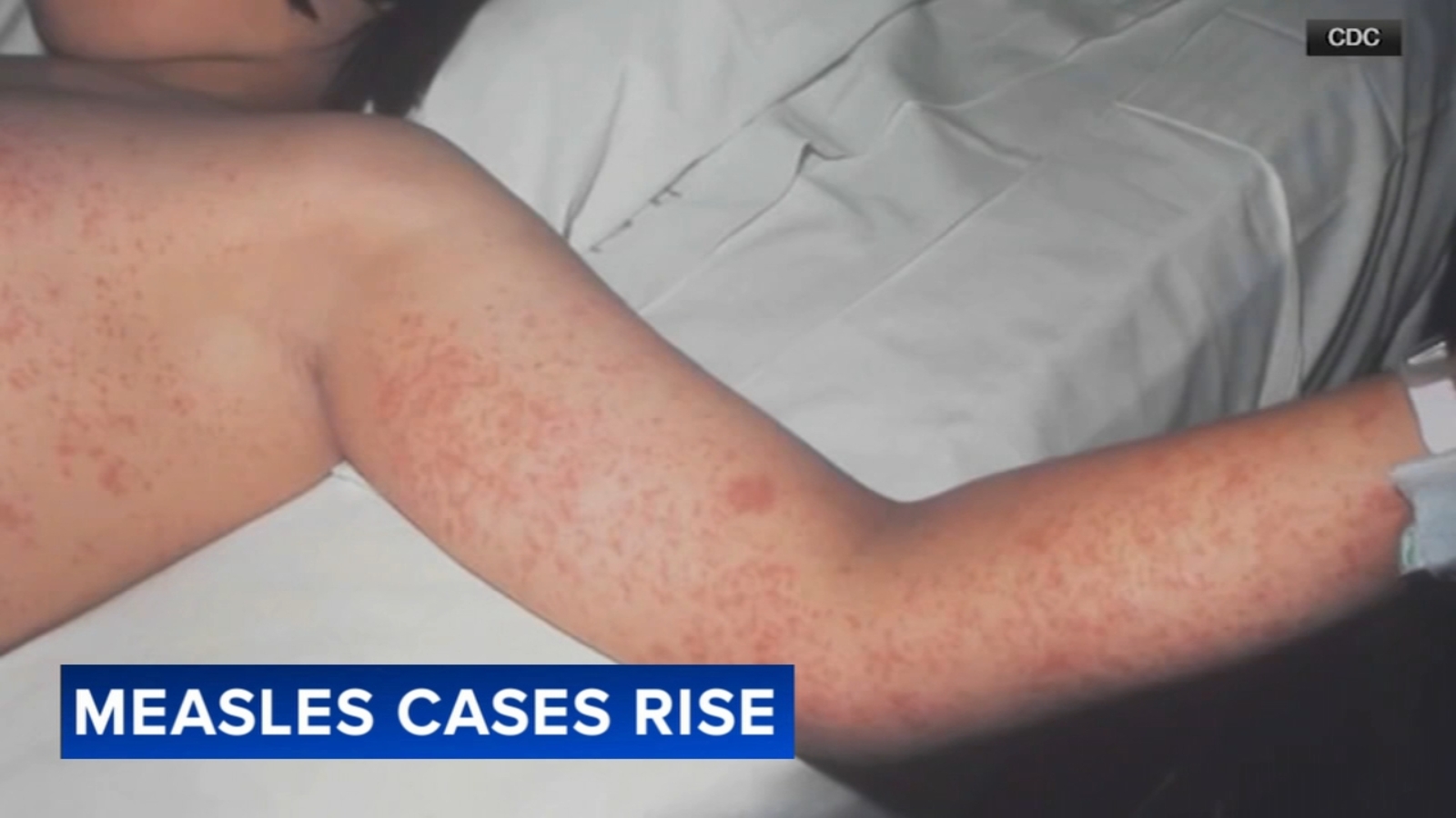 Measles cases rise as CDC lists first measles-related death; Philly doctor recalls 1991 outbreak