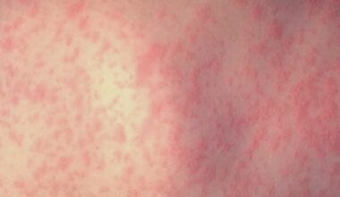 Pennsylvania surpasses 900 measles cases, with 13 new confirmed infections, as outbreak continues to spread: Officials