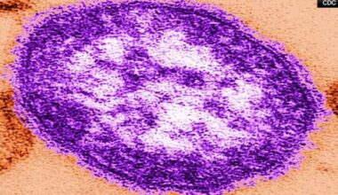 DOH confirms fourth measles-associated death in Pennsylvania | Pennsylvania News