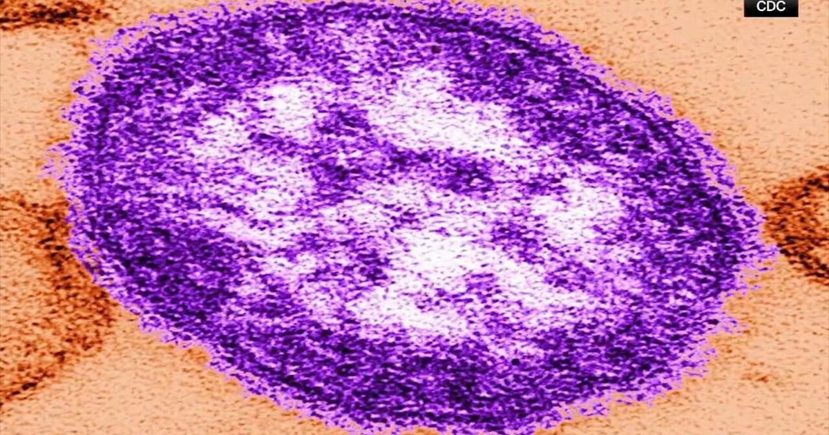 DOH confirms fourth measles-associated death in Pennsylvania | Pennsylvania News