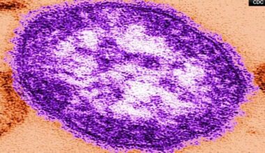 Pa. officials confirm fifth measles case in Berks Co. | Berks Regional News