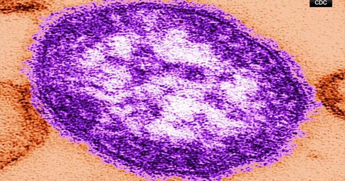 Pa. officials confirm fifth measles case in Berks Co. | Berks Regional News