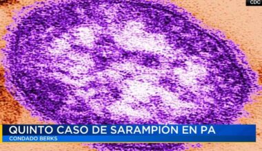 Confirman quinto caso de sarampión en el condado Berks | Noticias