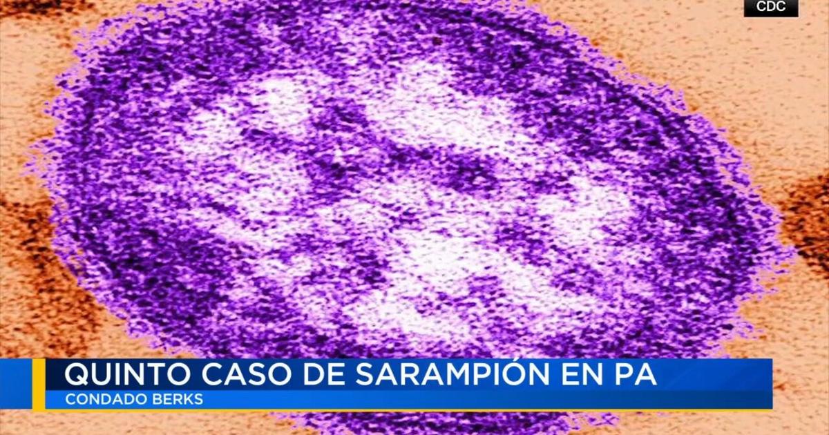 Confirman quinto caso de sarampión en el condado Berks | Noticias