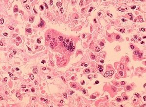 Pennsylvania surpasses 900 measles cases