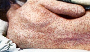 Pennsylvania’s Measles Outbreak Is Now the Single Worst of the Last 35 Years, and Still Climbing