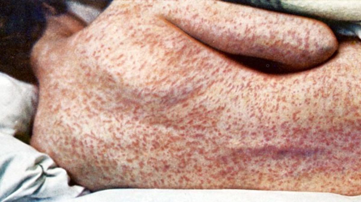 Pennsylvania’s Measles Outbreak Is Now the Single Worst of the Last 35 Years, and Still Climbing