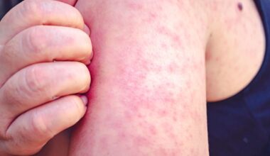 Pennsylvania Measles Outbreak Reaches Nearly 900 Cases