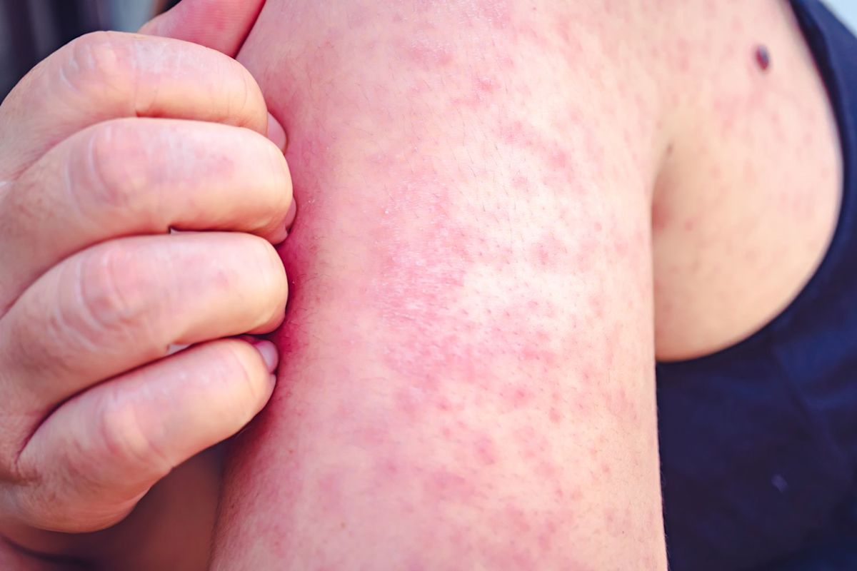 Pennsylvania Measles Outbreak Reaches Nearly 900 Cases