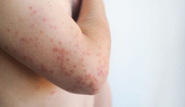 Why CDC counts only 1 measles death while Pennsylvania reports 4