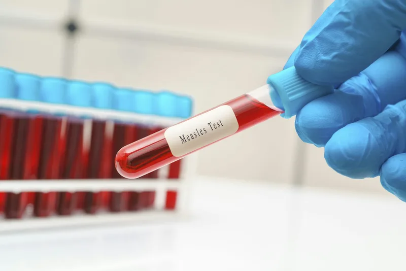 Measles Deaths Dispute Between Pennsylvania and Federal Health Officials Leaves Families Without Clear Answers