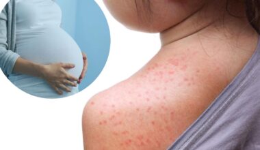 ‘New forms of measles’ emerge in Pennsylvania as cases surge