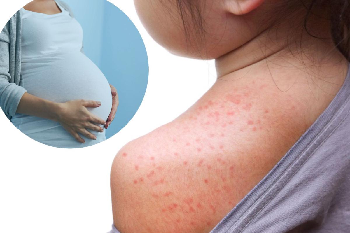 ‘New forms of measles’ emerge in Pennsylvania as cases surge