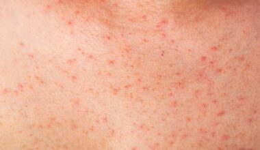 Latest measles numbers as contact tracing continues in Western PA