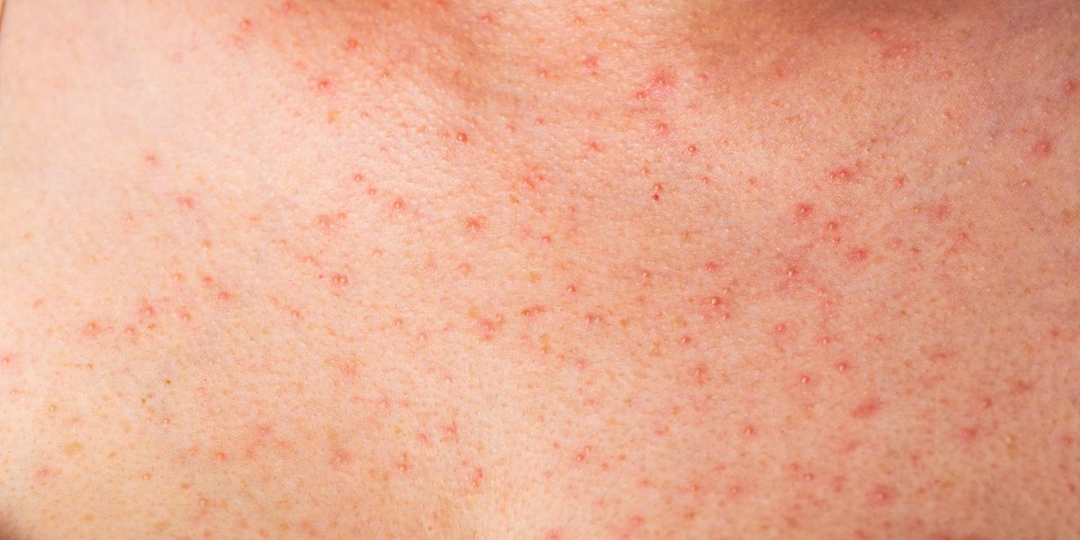Latest measles numbers as contact tracing continues in Western PA