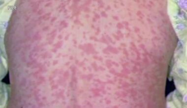 Pennsylvania confirms 4 measles deaths; outbreak grows to 693 cases in 38 counties