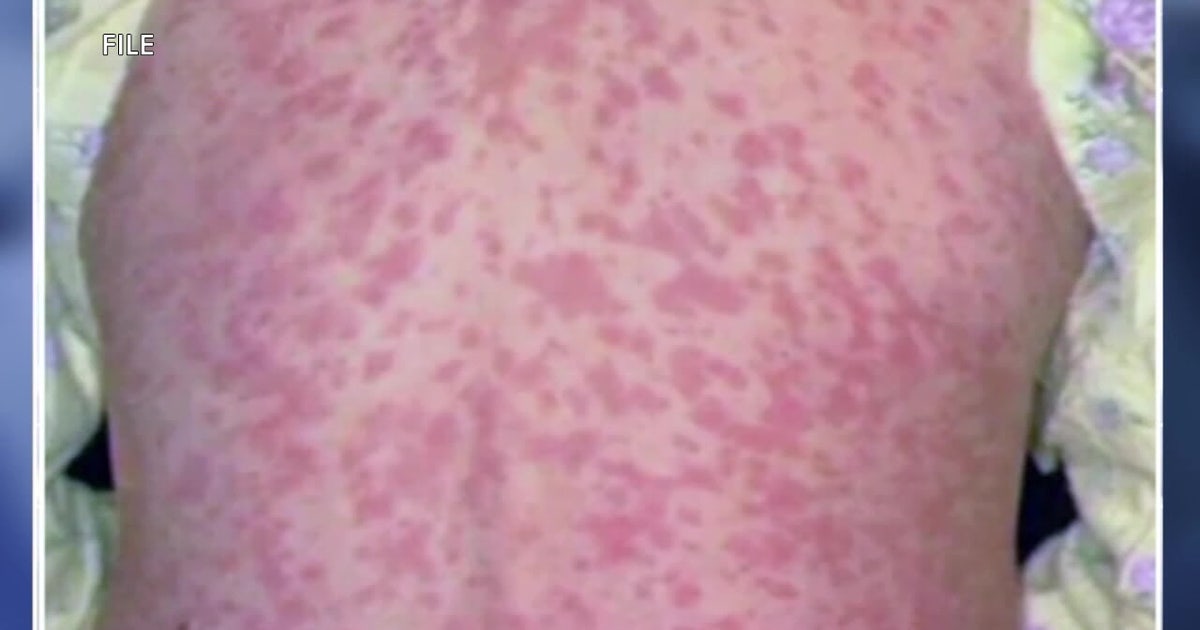 Pennsylvania confirms 4 measles deaths; outbreak grows to 693 cases in 38 counties