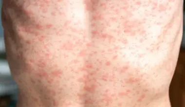 Measles Outbreak, Cases Reach 1,338 in 44 Counties in Pennsylvania