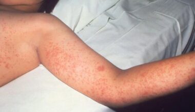 Health Beat: CDC investigates deadly measles outbreak in Pennsylvania | Health Beat