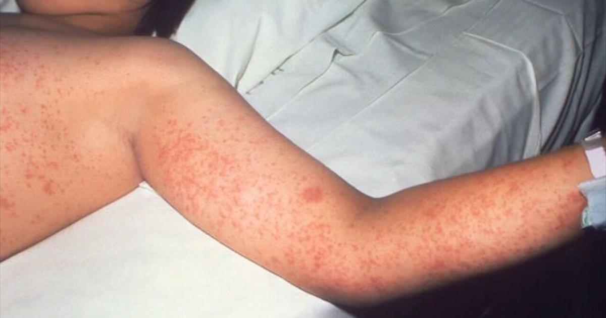 Health Beat: CDC investigates deadly measles outbreak in Pennsylvania | Health Beat