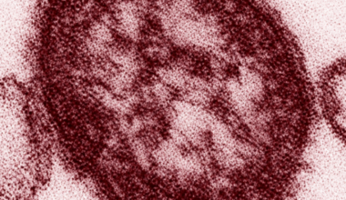 Measles milestones: US closes in on 4,000 cases as Pennsylvania nears 1,000