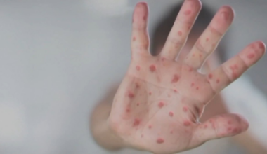 Pennsylvania expands vaccine access amid measles outbreak – NBC10 Philadelphia