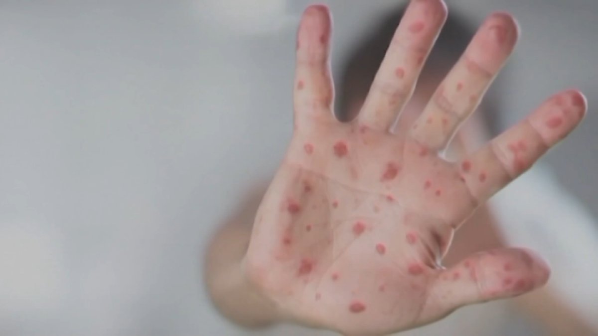 Pennsylvania expands vaccine access amid measles outbreak – NBC10 Philadelphia