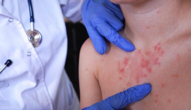 Possible measles exposures reported in Chester County, Pennsylvania, as outbreak grows