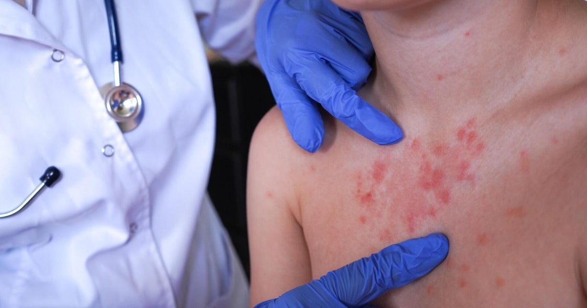Possible measles exposures reported in Chester County, Pennsylvania, as outbreak grows