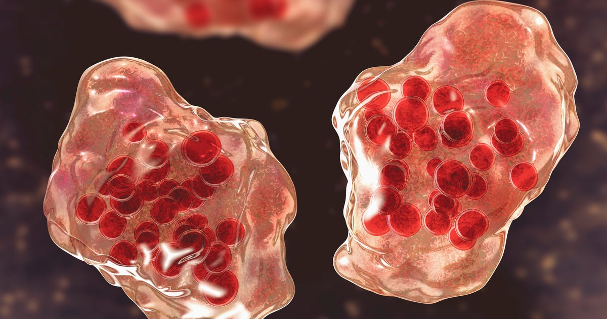 5th measles-associated death reported in Pennsylvania, health officials say