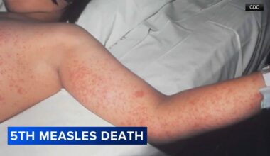 5th measles-related death reported in Pennsylvania