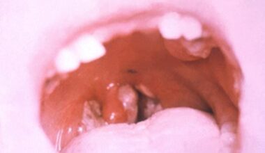 Diphtheria case reported in Erie County, NY