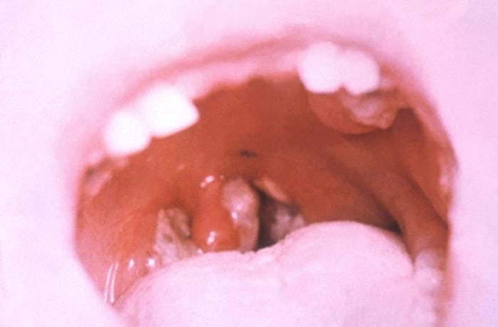 Diphtheria case reported in Erie County, NY