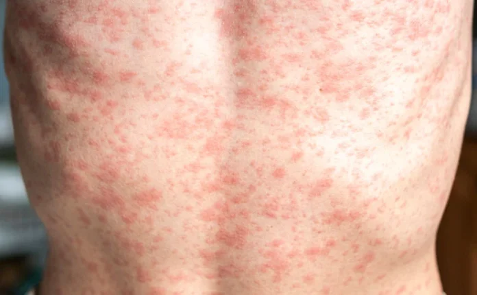 measles