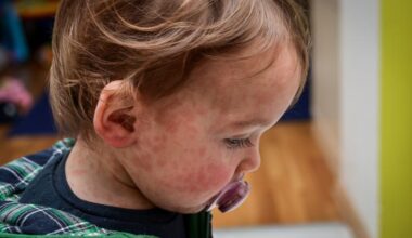 Pennsylvania confirms more than 1,000 measles cases