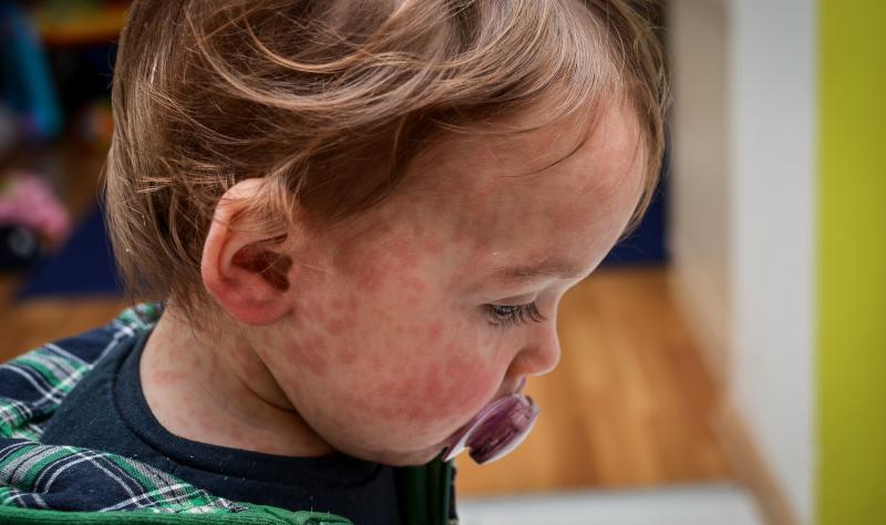 Pennsylvania confirms more than 1,000 measles cases