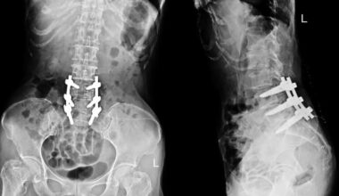 Minimally Invasive Neurosurgery of Texas Shares Breakthrough