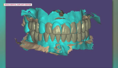 AI-driven smile design at Texas Dental Implant Center