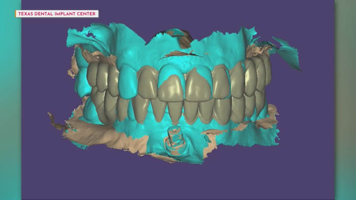 AI-driven smile design at Texas Dental Implant Center