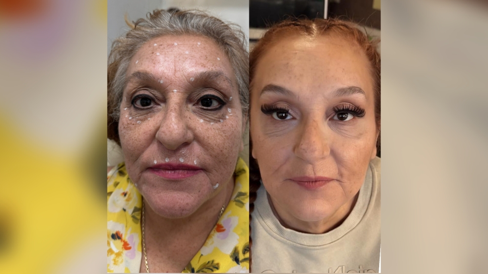 Photo of a woman before and after using Pickture Perfect Medspa services