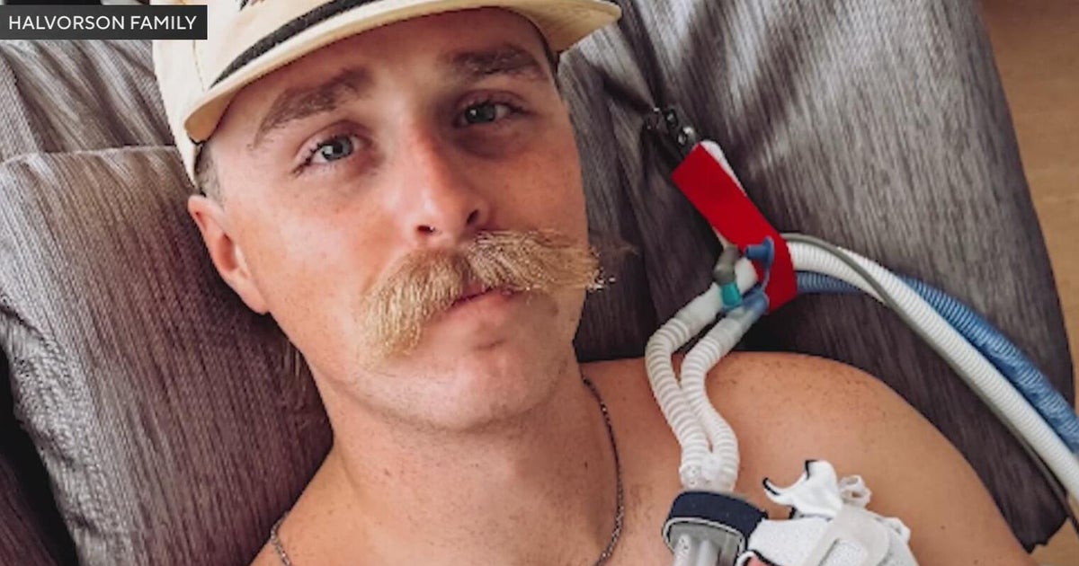 Severely burned Fort Worth firefighter to get workers' comp after outrage over denied care