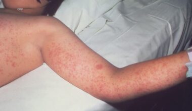 North Texas measles count raises to 5, health officials say