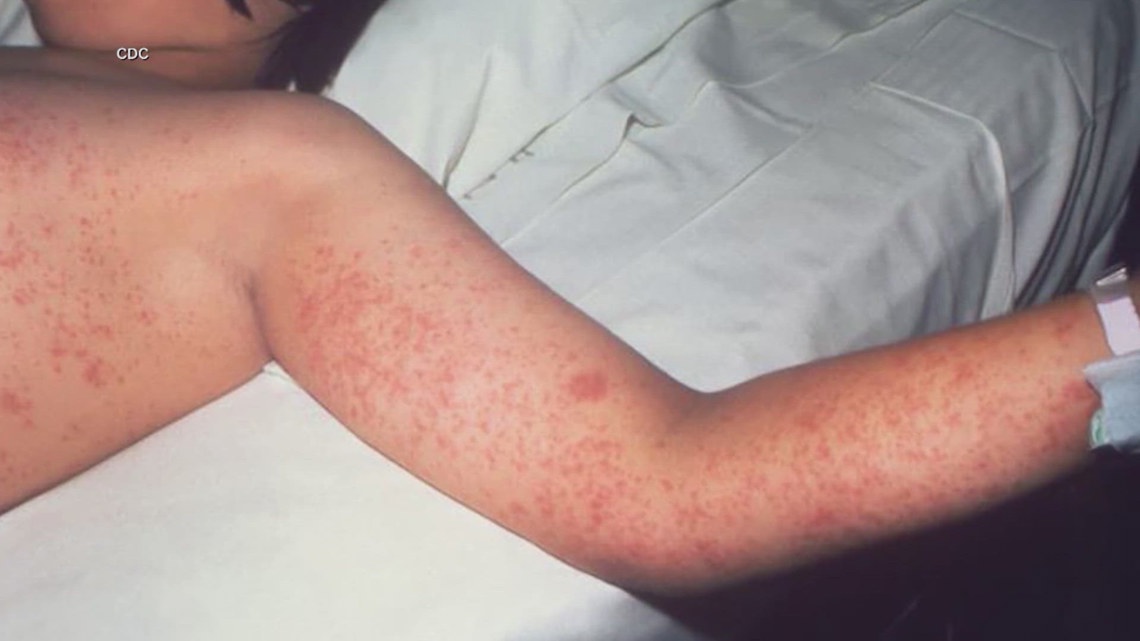 North Texas measles count raises to 5, health officials say
