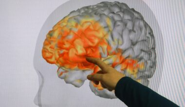 Concussions may be underreported in Dallas-Fort Worth schools, study finds