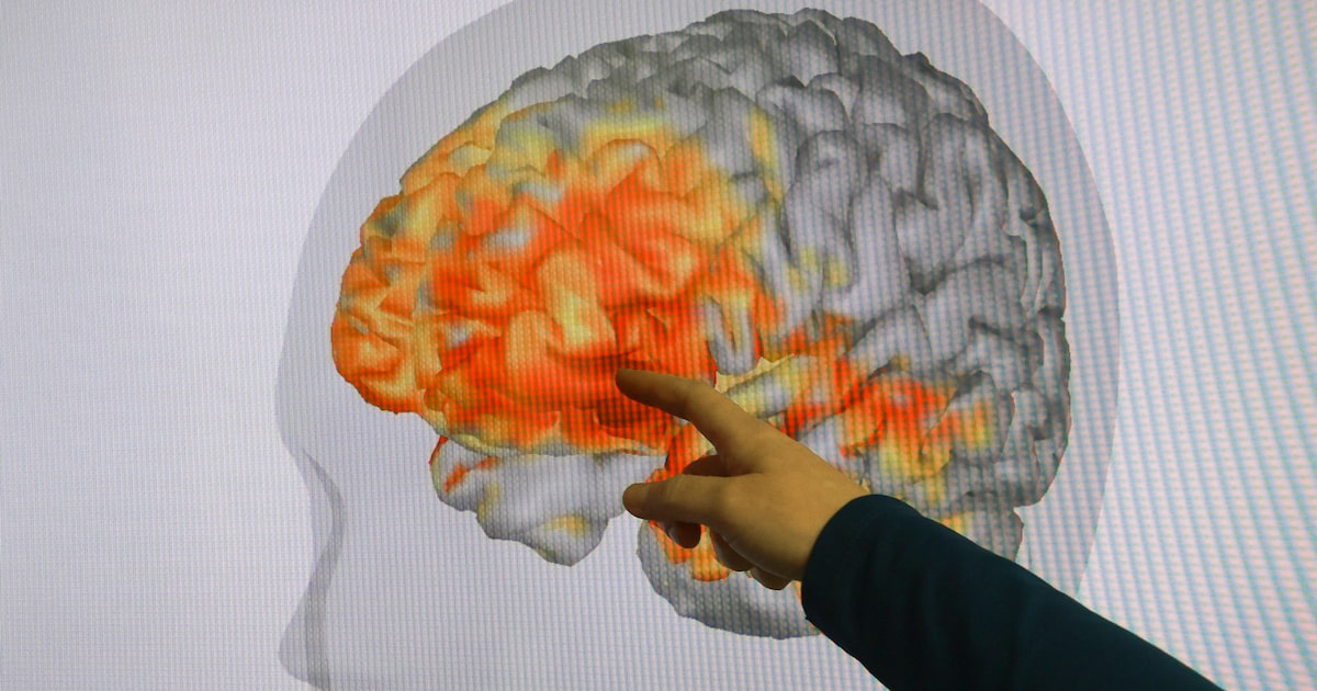 Concussions may be underreported in Dallas-Fort Worth schools, study finds