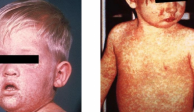 4 measles cases confirmed in El Paso