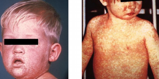 4 measles cases confirmed in El Paso