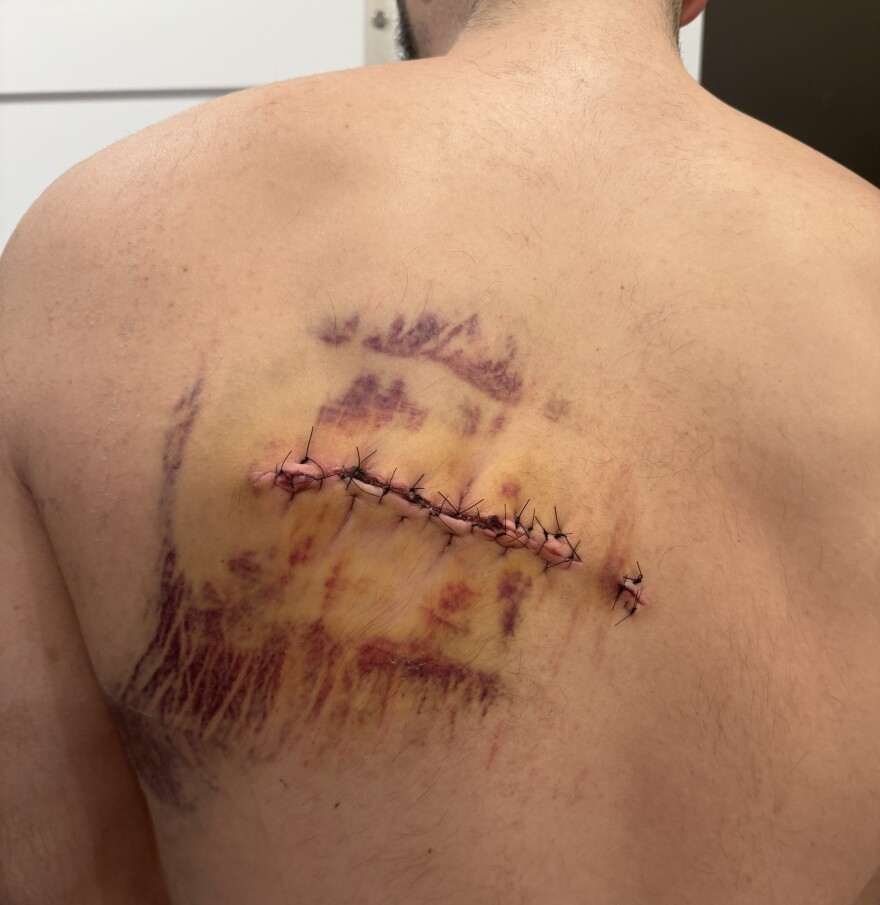 The bullet wound with stitches is shown on a man's back.