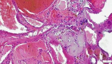 Understanding adenoid cystic carcinoma: Symptoms, treatment and outlook