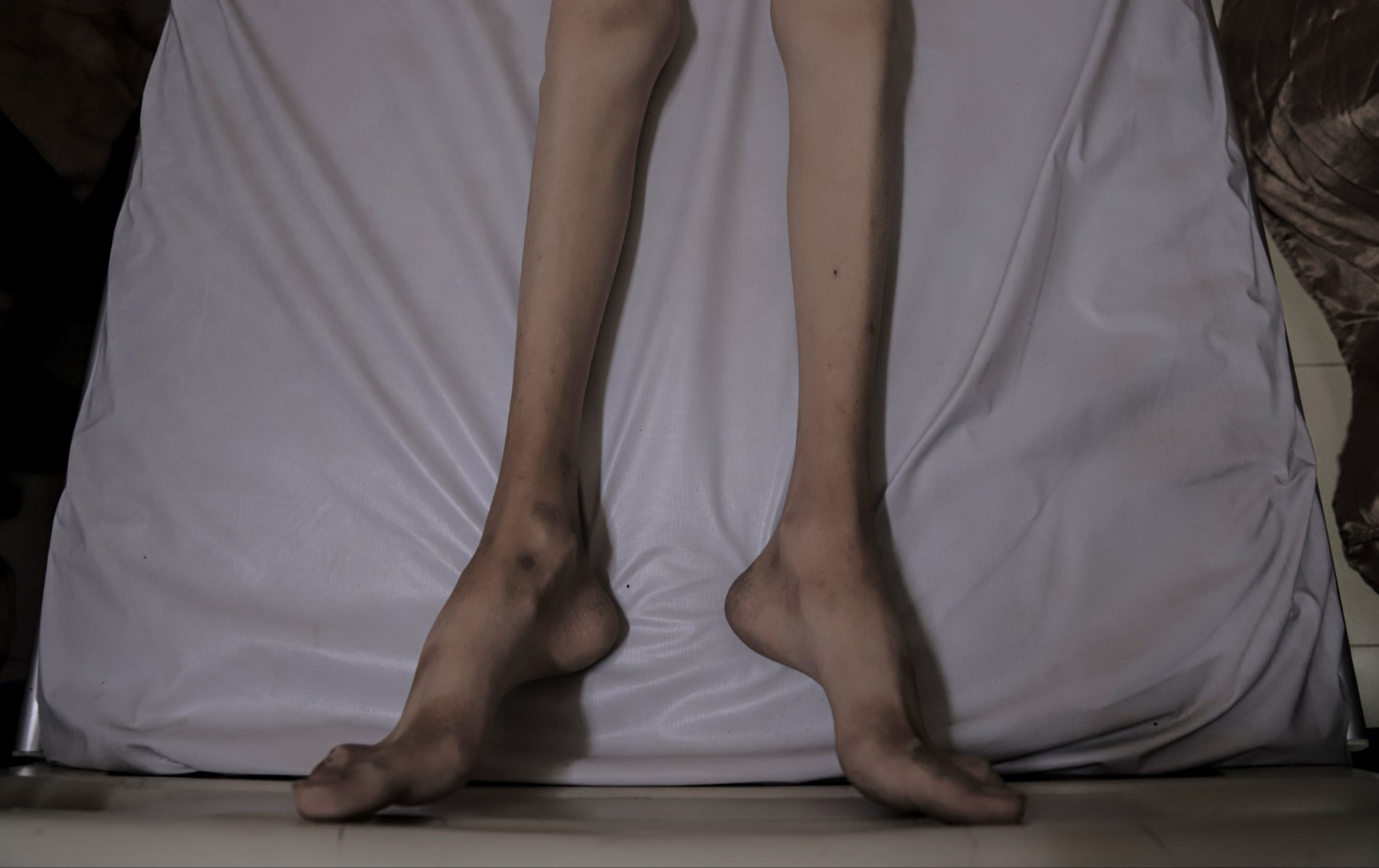 Seventeen-year-old Ayman Nasir al-Nunu, who suffered from malnutrition, receives treatment at the Patient Friends Association Hospital in Gaza City, Gaza on October 29, 2025.